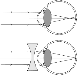 Kurzsichitgkeit - Erklärung